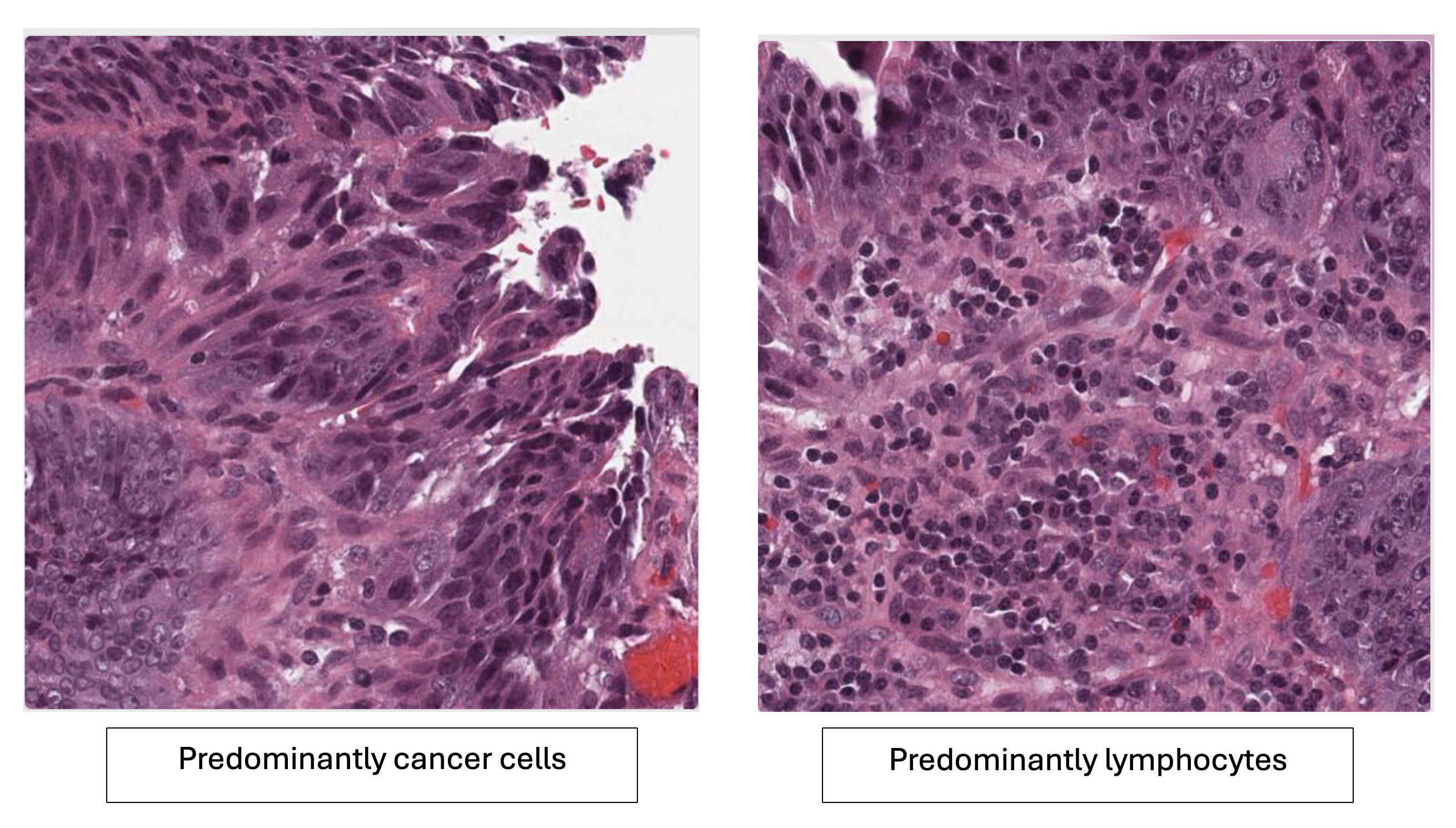 Comparison of histopathology images showing cancer cells vs lymphocytes